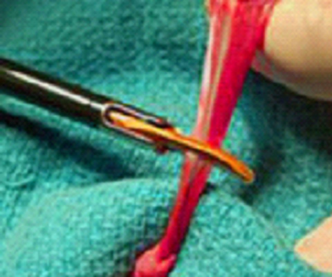 超音波メスで血管を切離している様子