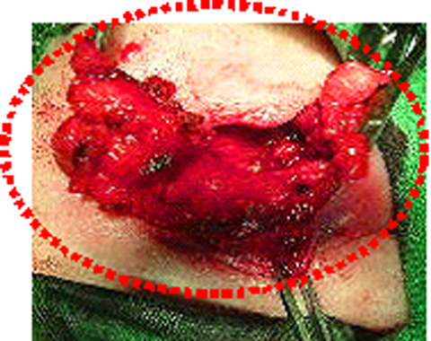 肉芽腫を摘出しているところ