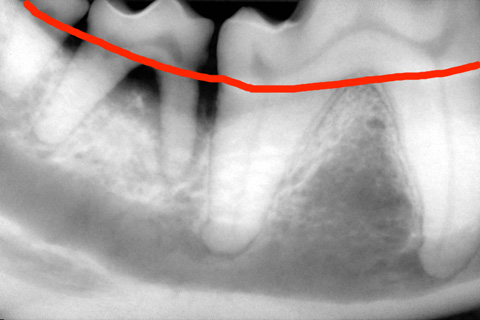 歯のレントゲン写真