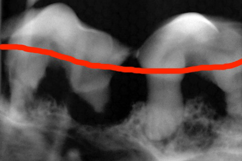 歯のレントゲン写真